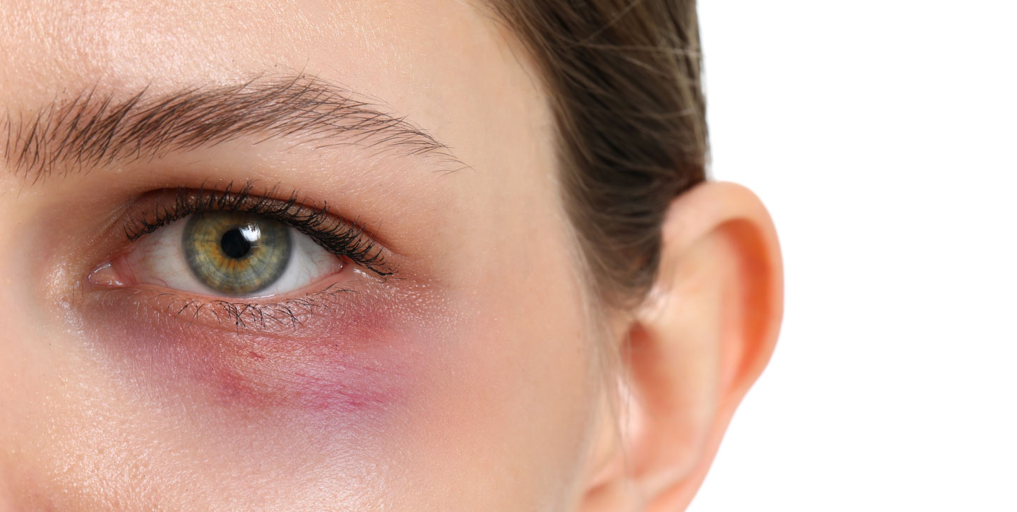 why-you-should-avoid-under-eye-filler-a-candid-look-at-the-risks-thumbnail