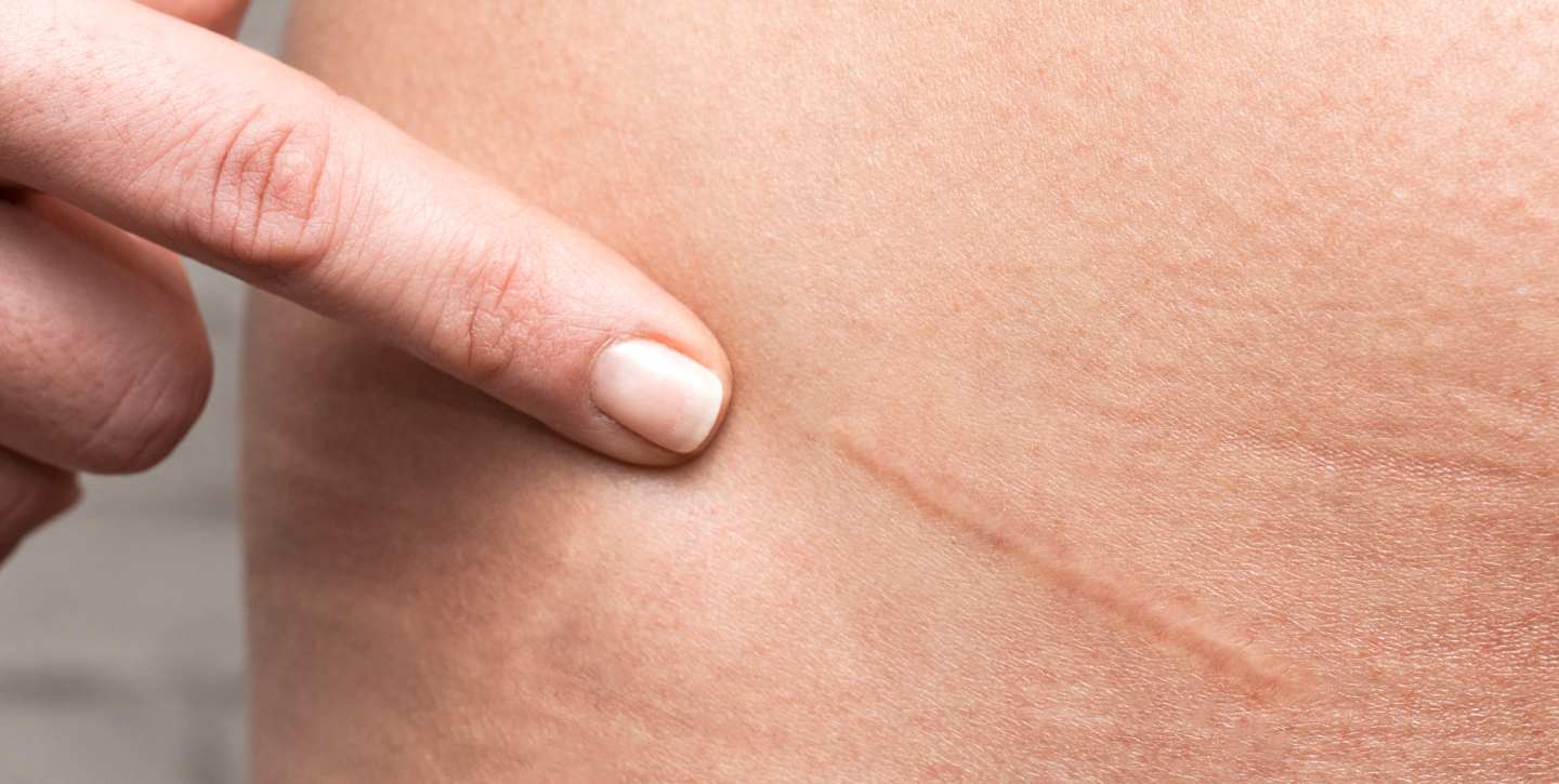 how-long-do-plastic-surgery-scars-take-to-heal-thumb-1440-725