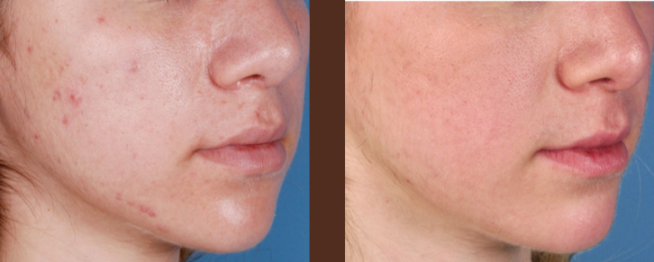 what-does-red-light-therapy-do-inner-thumb-2-767-291