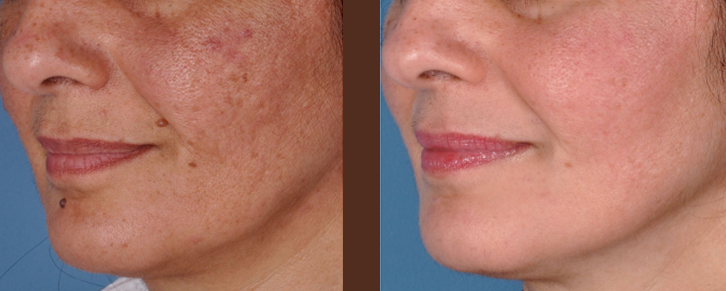 what-does-red-light-therapy-do-inner-thumb-3-767-291