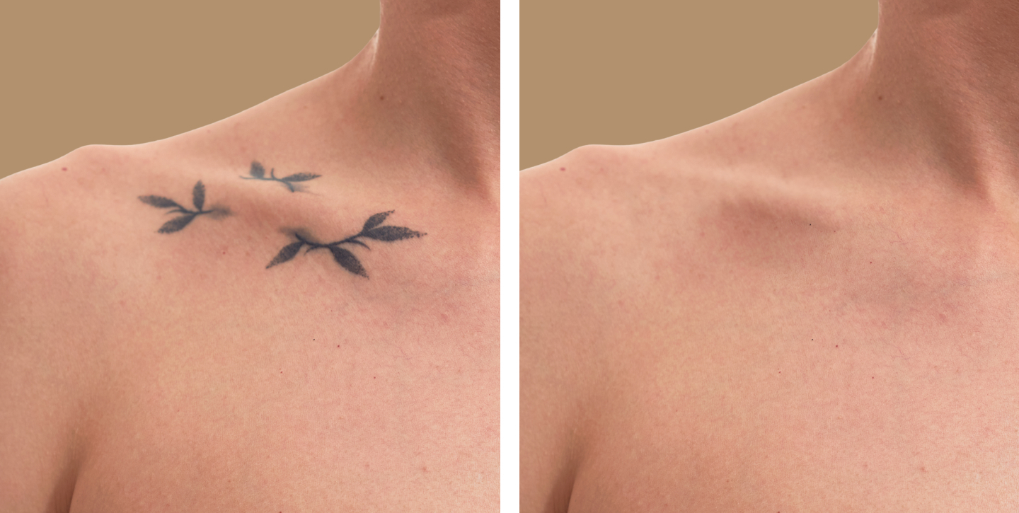 can-tattoos-be-surgically-removed-thumbnail-1440-725